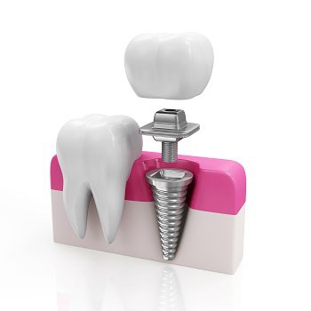 Early and Late Dental Implants failure.