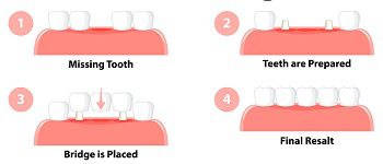 Dental Bridge: Benefits and Care