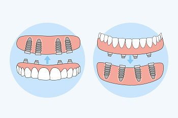 How do All-on-4 dental implants improve your overall dental health?