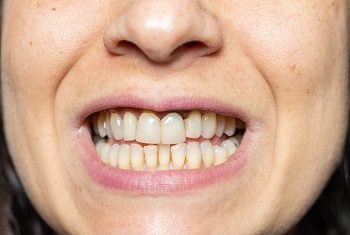 What are All-on-4 dental implants?