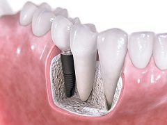 What is Involved With A Dental Implant Placement