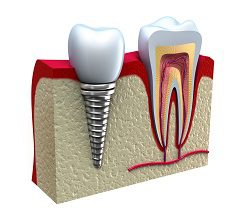Denture Alternatives - Dental Implants or All-On-Four