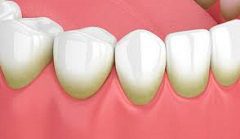 Periodontitis That Goes Untreated