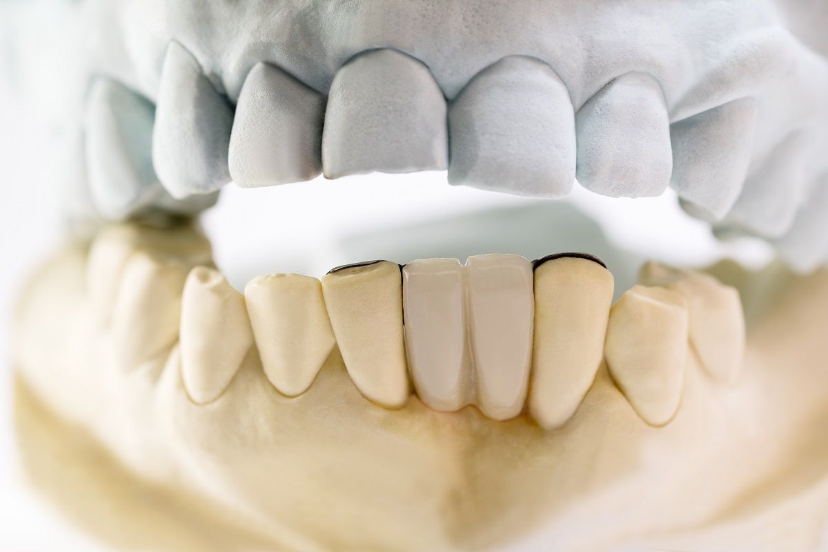 The pros and cons of dental bridges: Is it the right choice for your smile? 