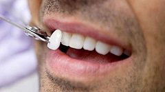 Dental Veneers for a Better Smile
