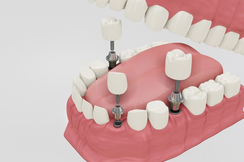 benefits-of-dental-implants.jpg