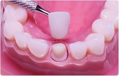 How Long Does A Dental Crown Procedure Take?