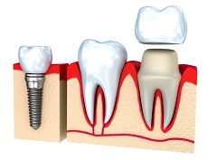 Why Dental Crowns Are A Great Option