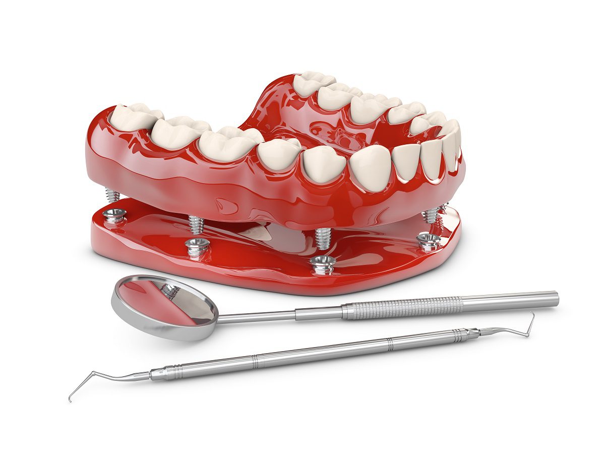 human-teeth-dental-implant-3d-illustration.jpg
