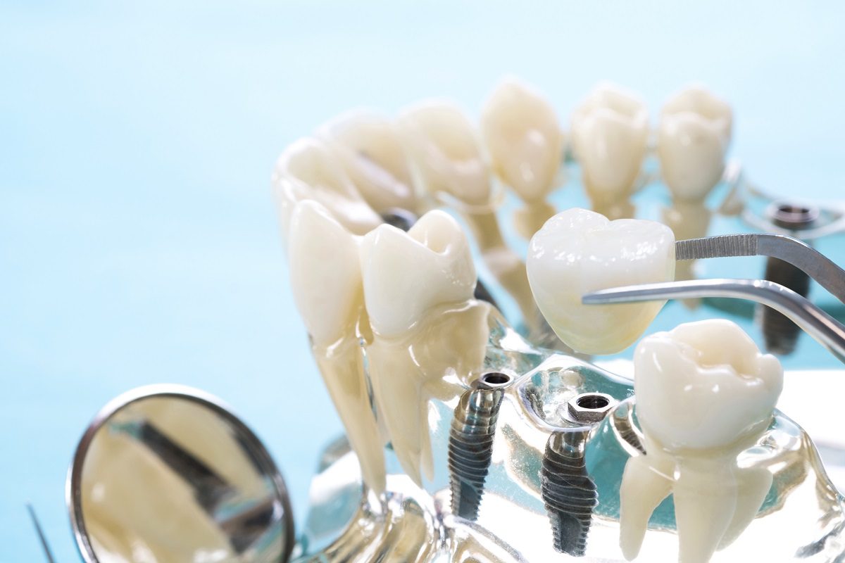 implan-model-tooth-support-fix-bridge-implan-crown.jpg