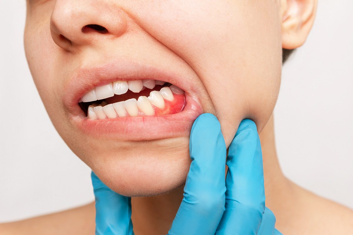 periodontitis-3.jpg