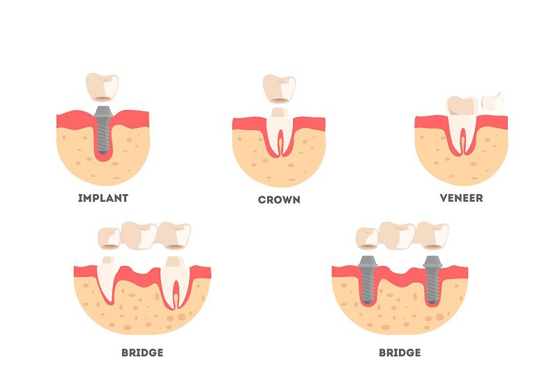 restorative-dentistry-options.jpg
